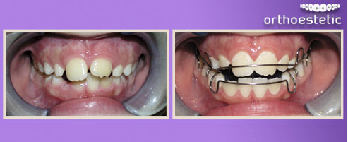 Children's Orthodontics
