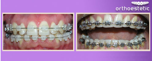 Fixed Orthodontics