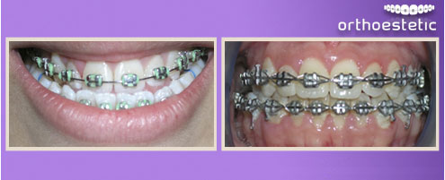 Pre surgery Orthodontics