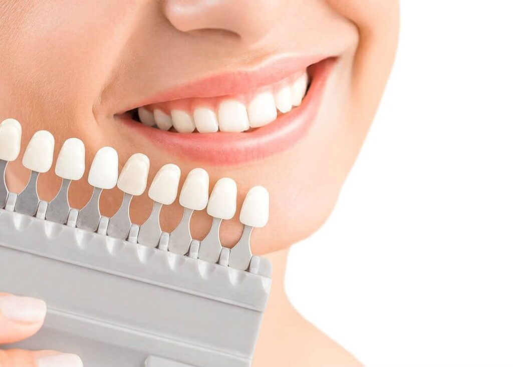 Carillas dentales, la revolución en la estética dental